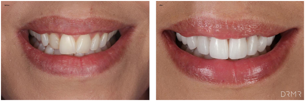 porcelain-veneers