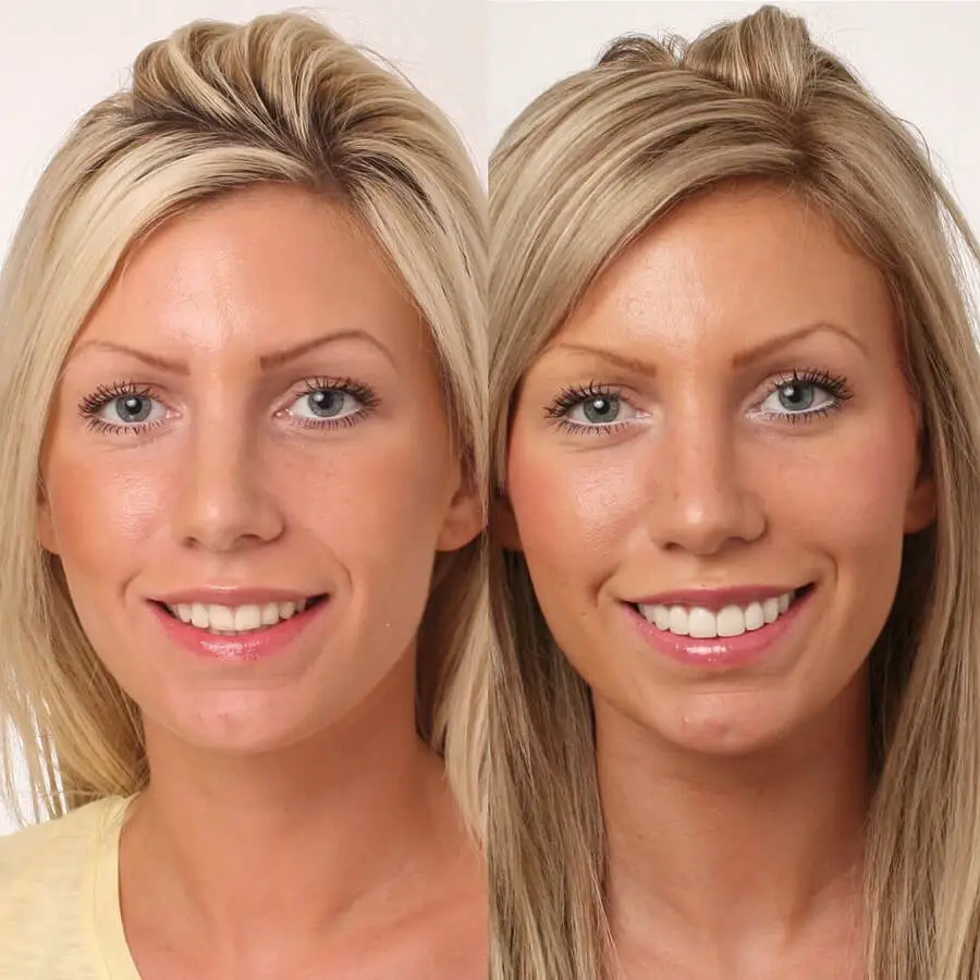 Before and after natural-looking porcelain veneers on a female patient, by Dr Manrina Rhode at DRMR Clinic, Knightsbridge
