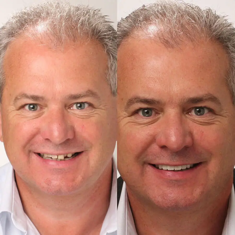 Before and after natural-looking porcelain veneers on a male patient, by Dr Manrina Rhode at DRMR Clinic, Knightsbridge