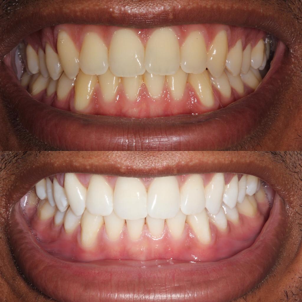 Teeth Whitening in London | DRMR