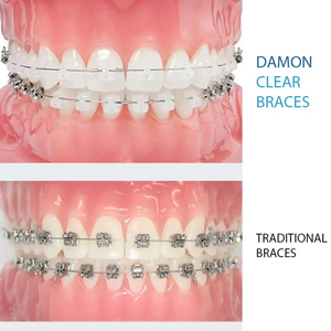 Damon Fixed Braces