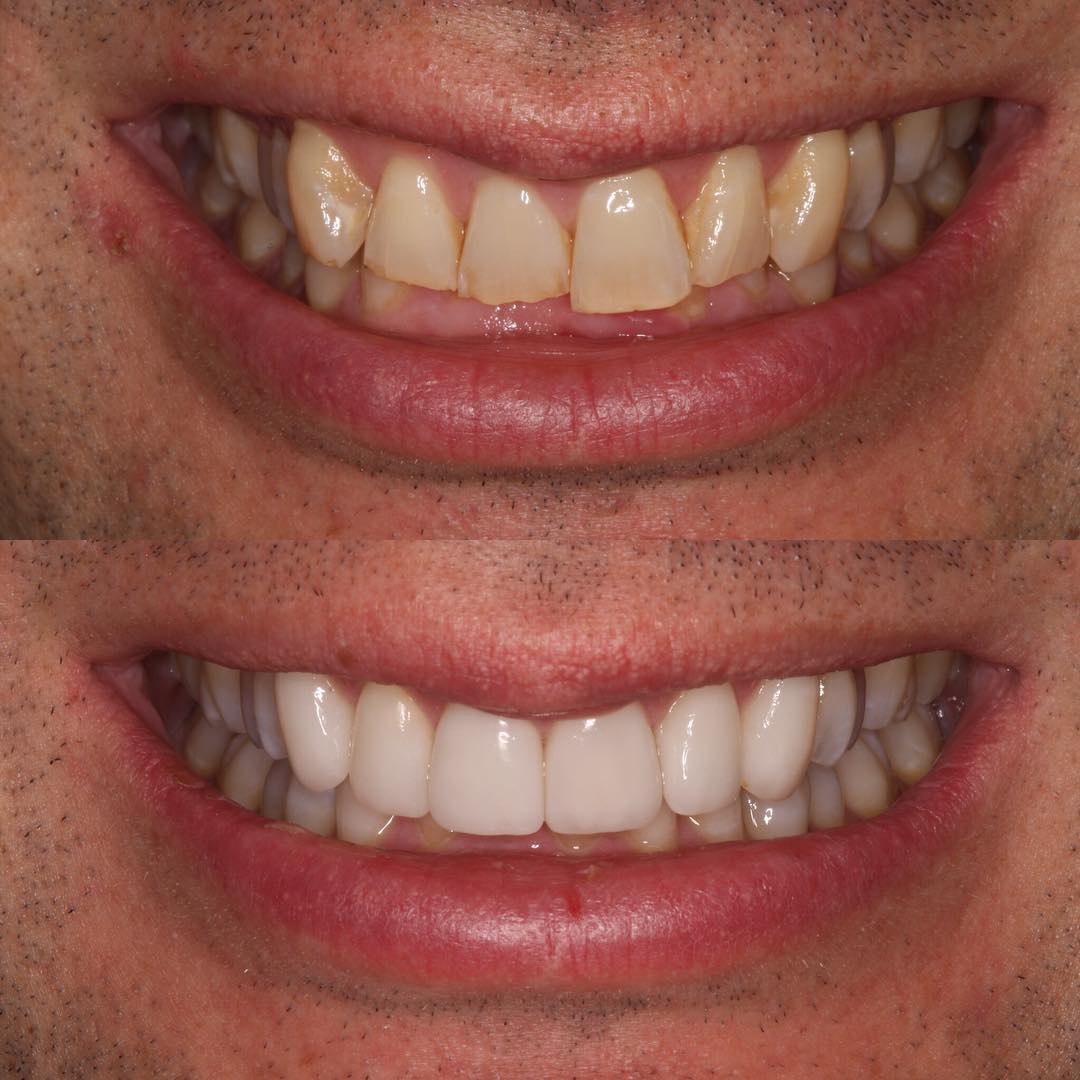 Veneers