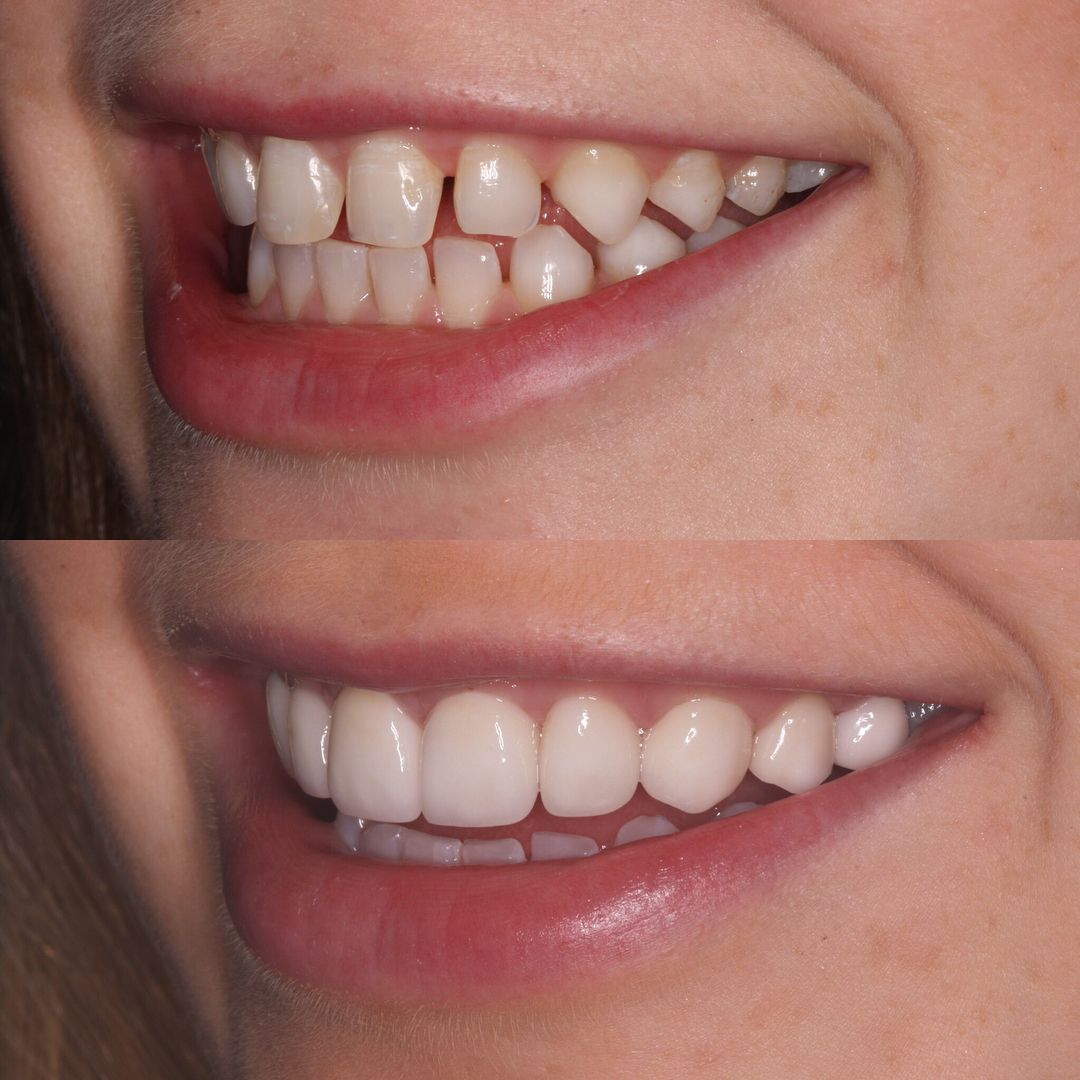 Veneers