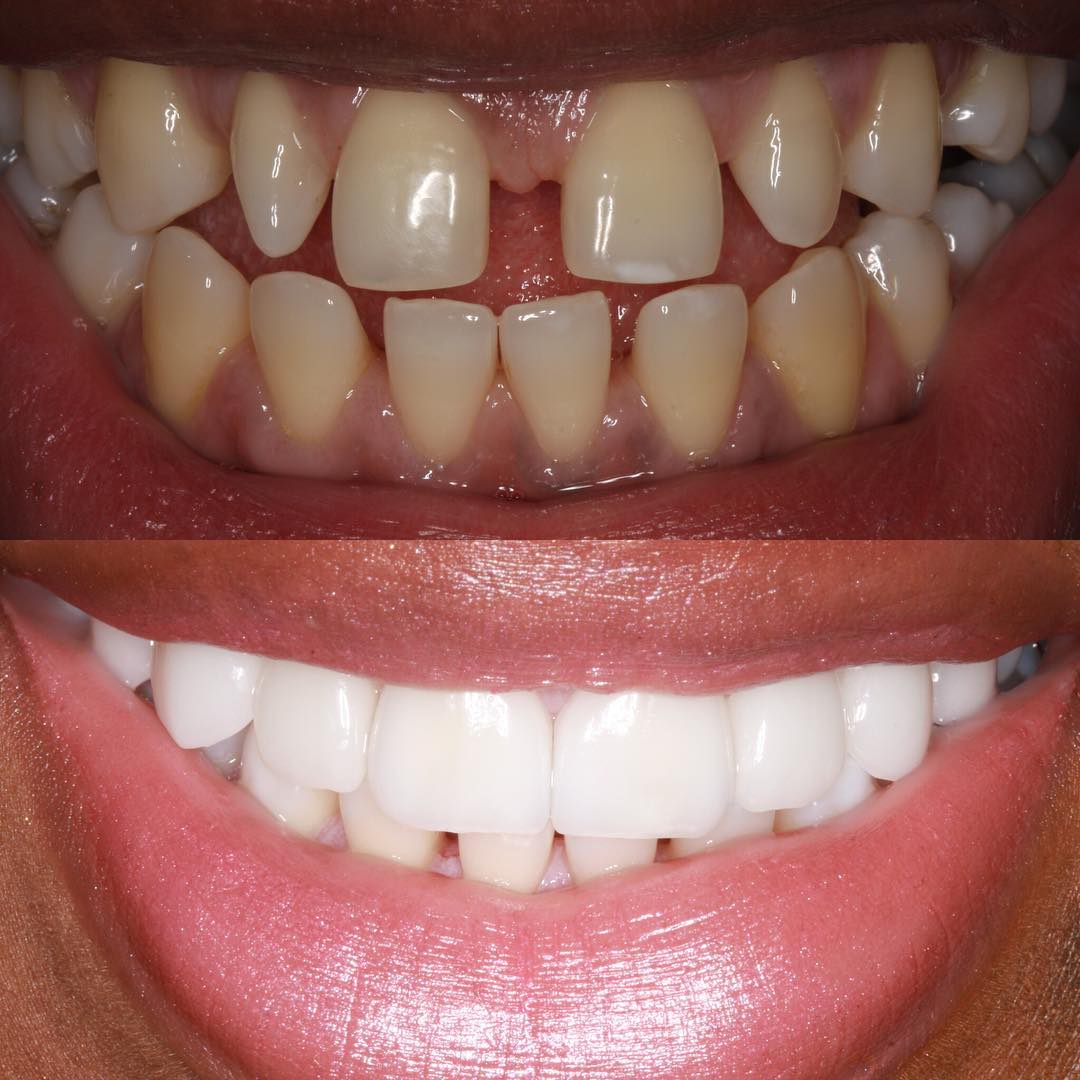 Veneers