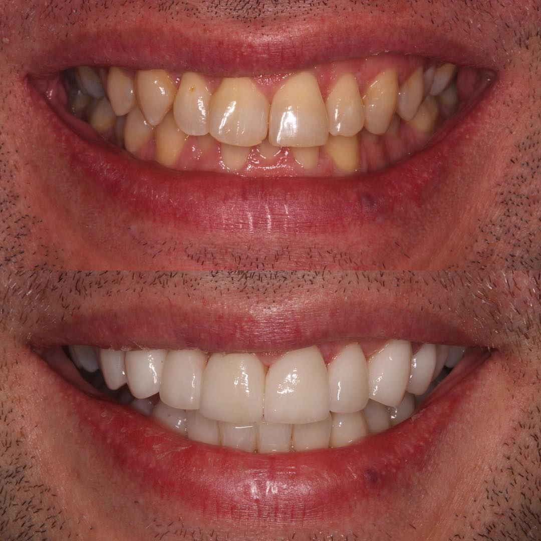 Veneers