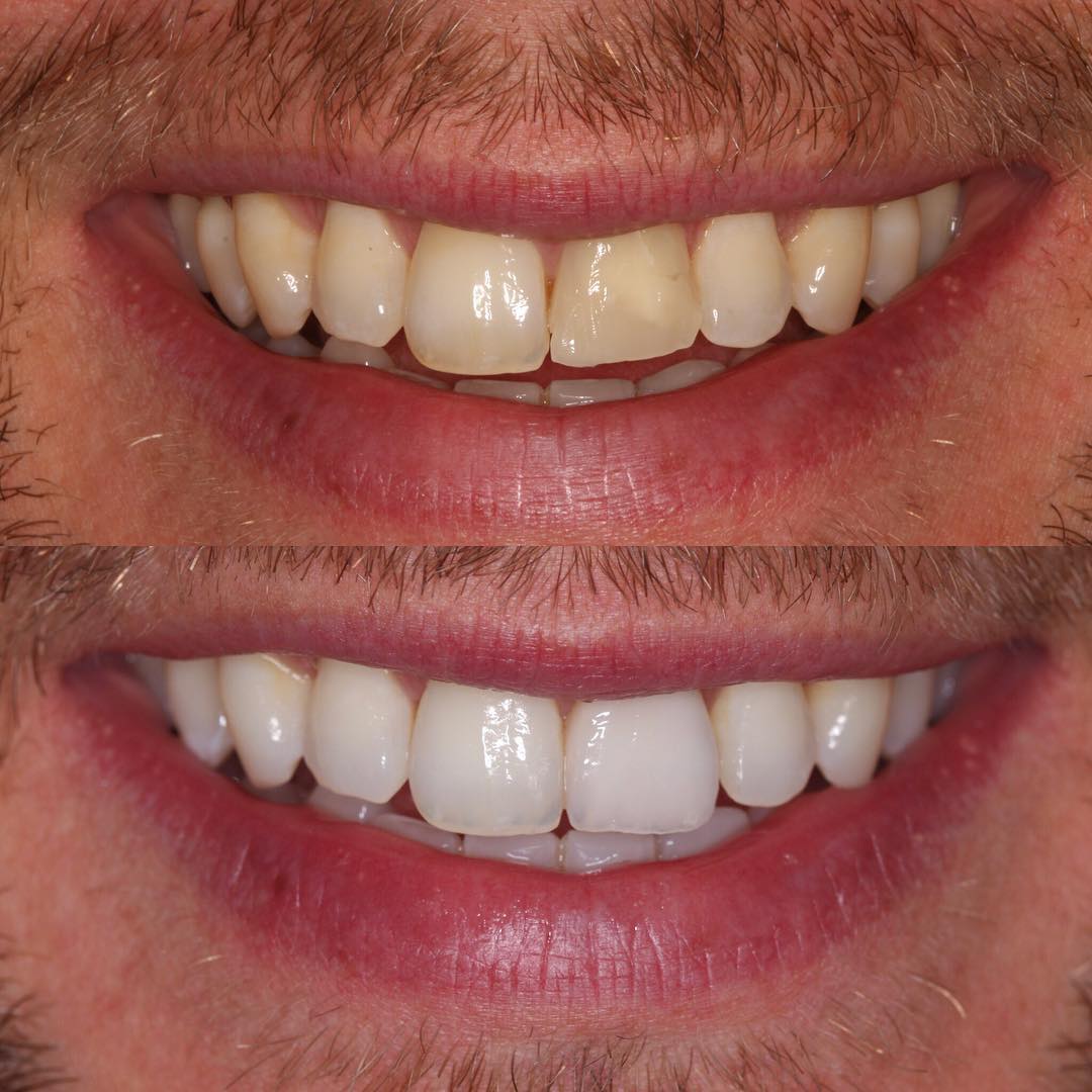 Veneers