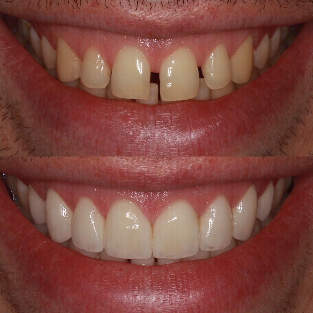 Veneers