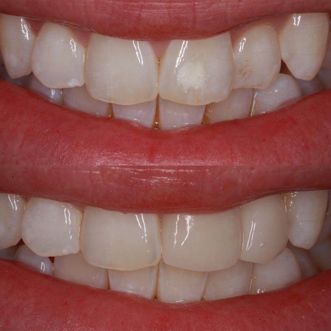 Veneers