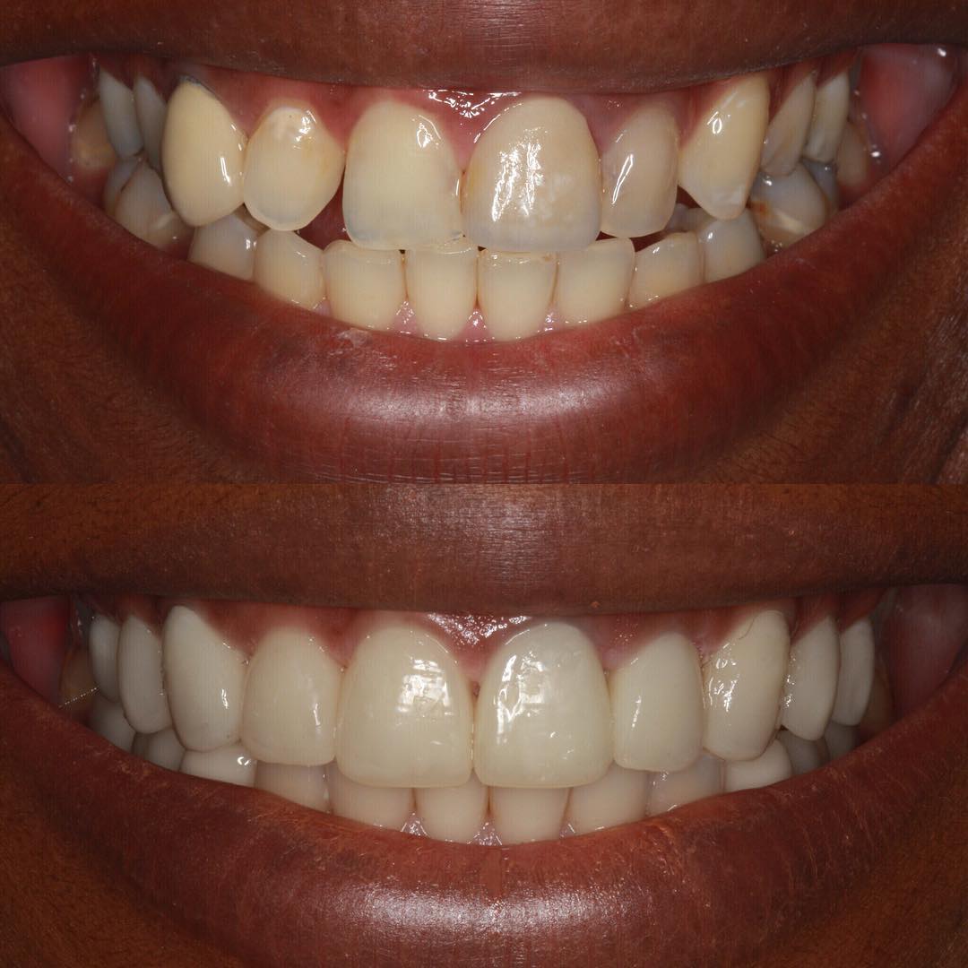 Veneers