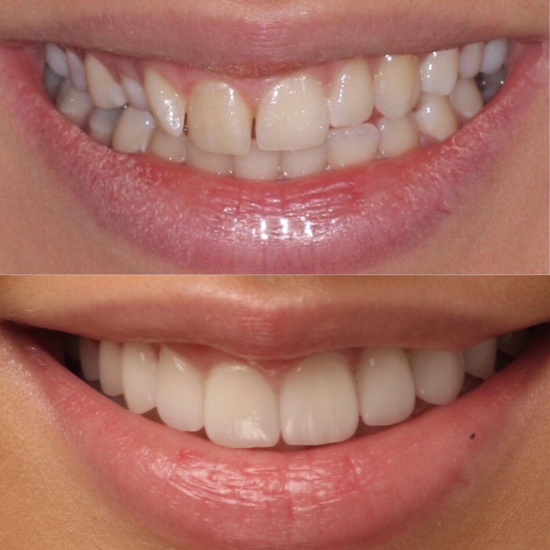 Veneers