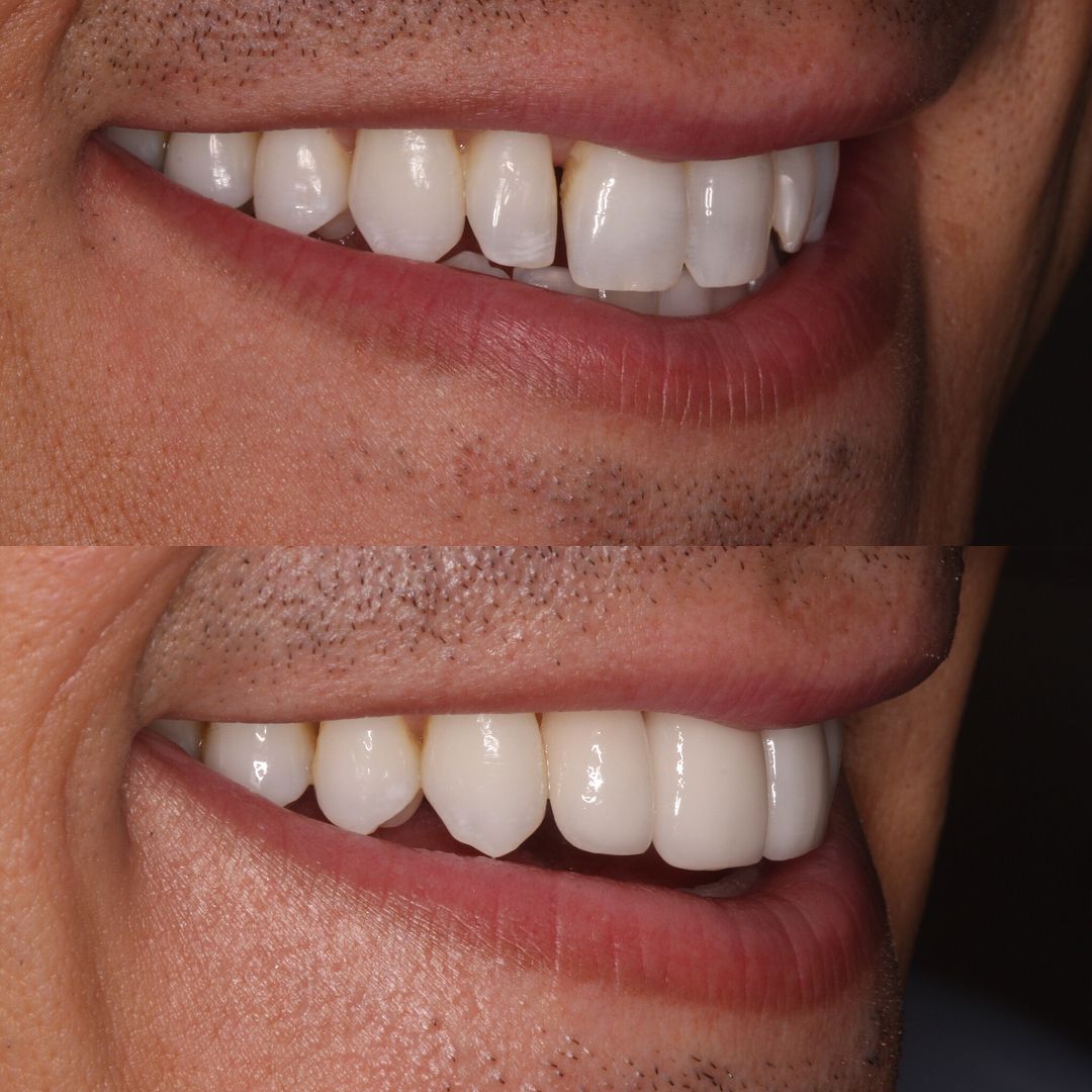 Veneers