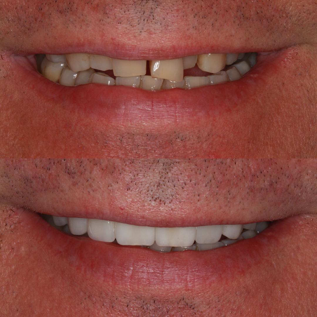 Veneers