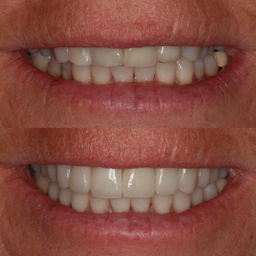 Veneers