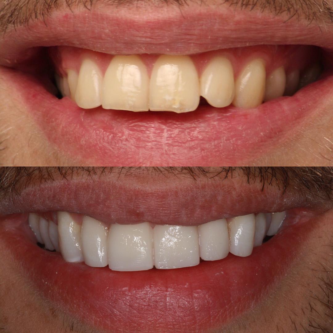 Veneers