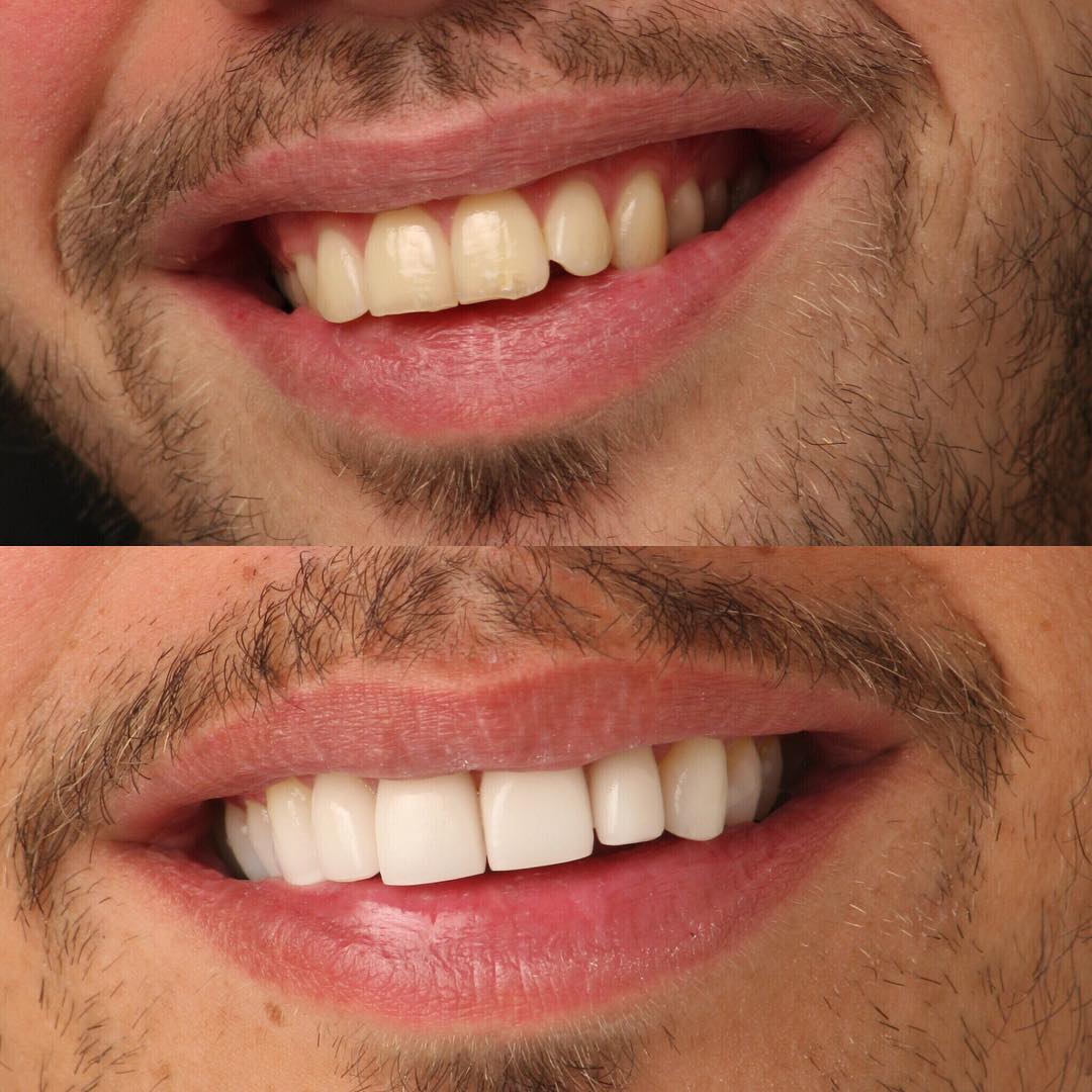 Veneers