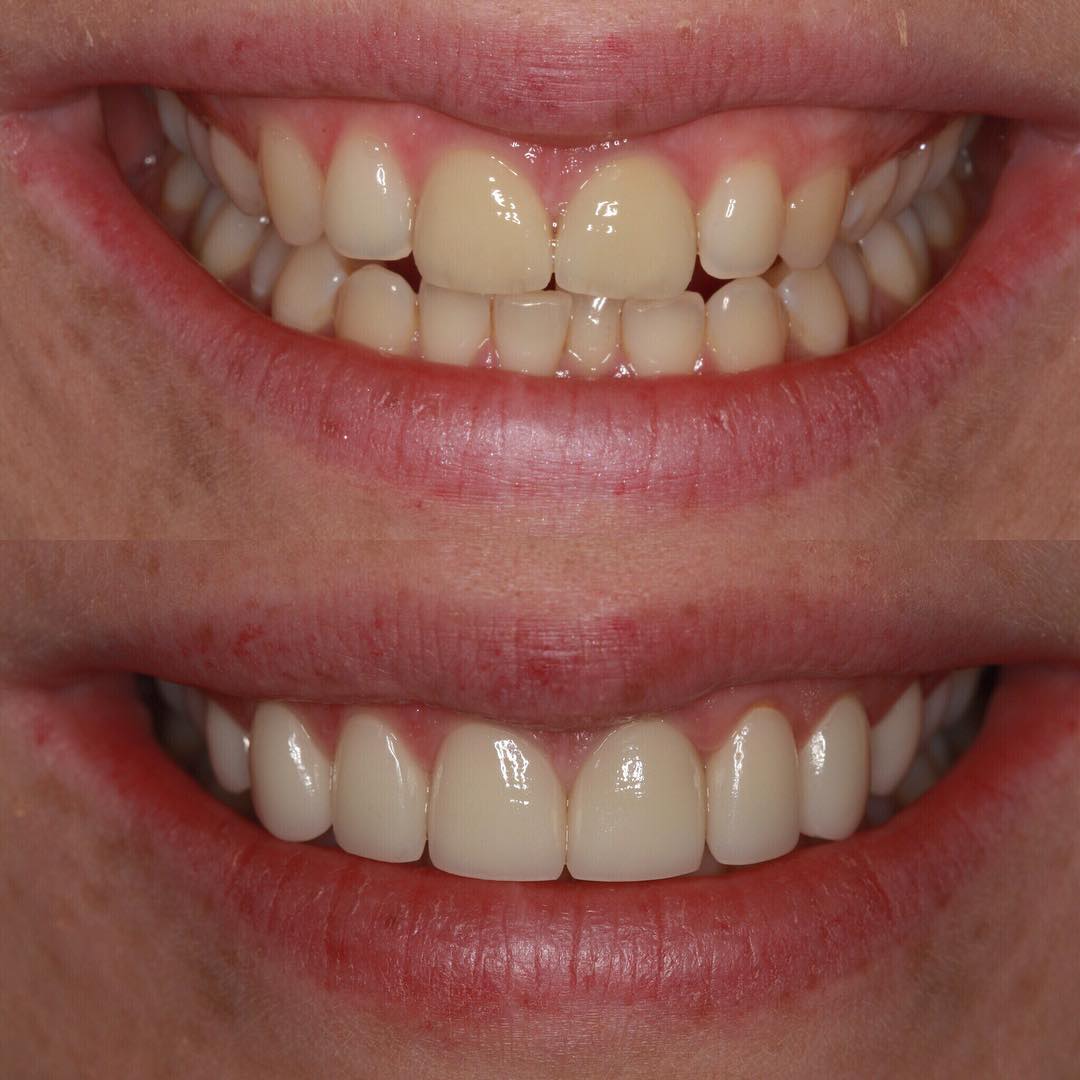 Veneers