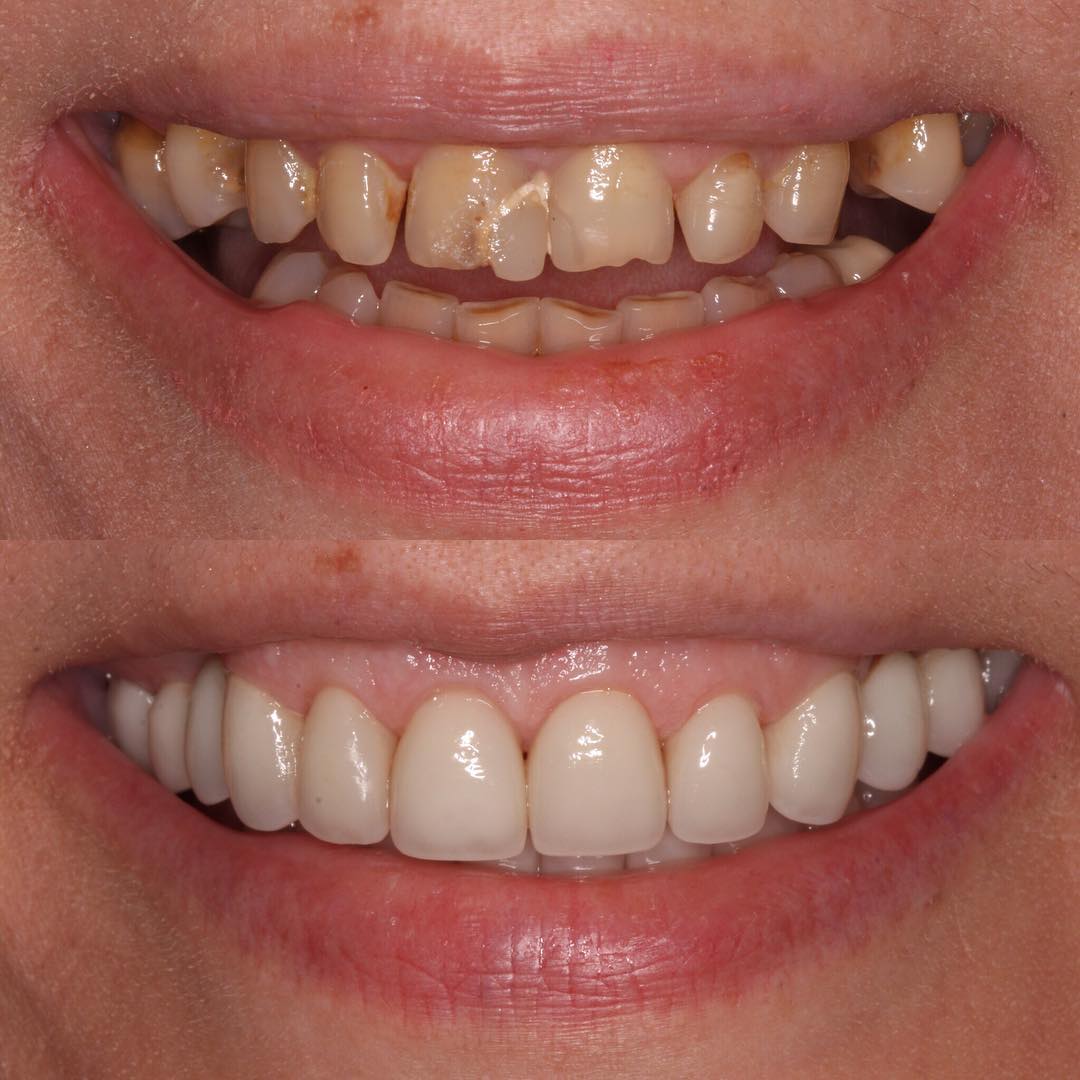 Veneers