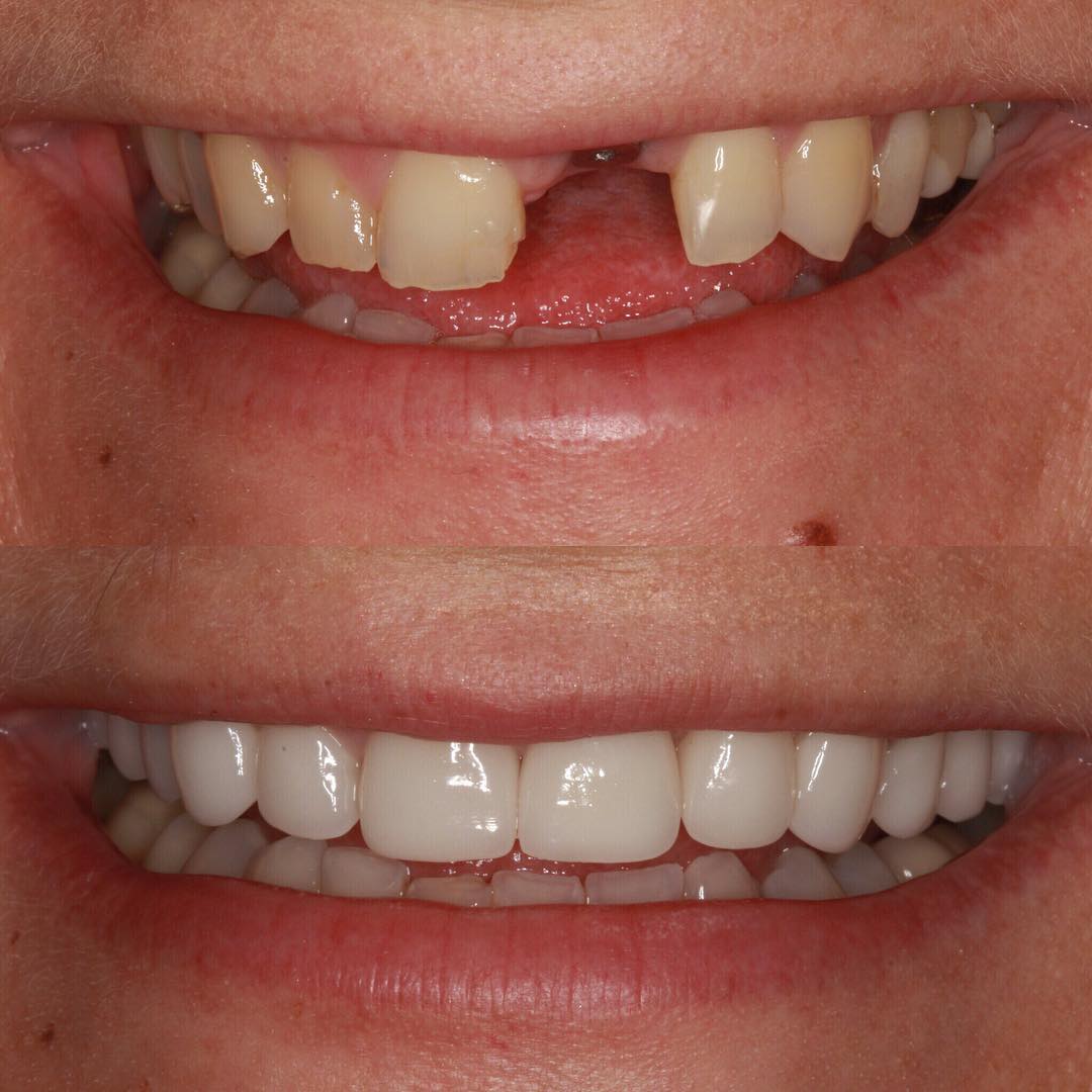 Veneers