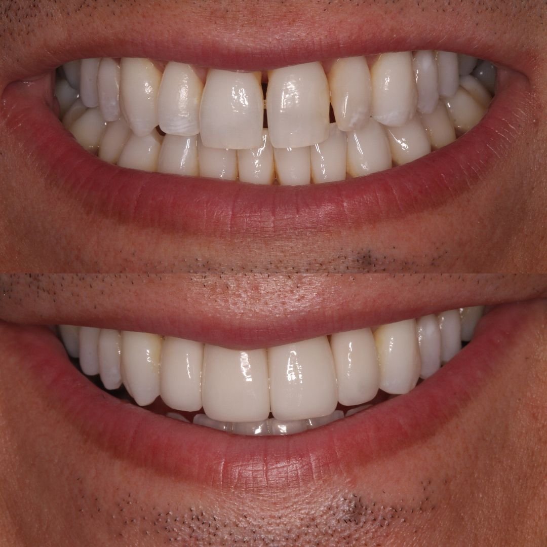 Veneers