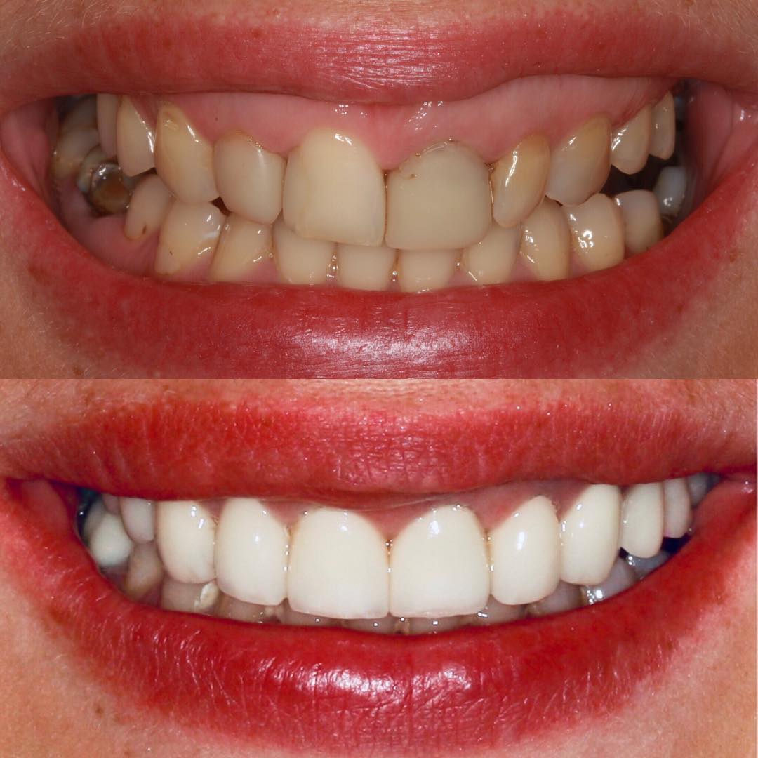 Veneers