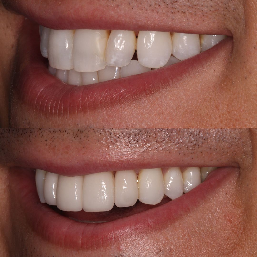 Veneers