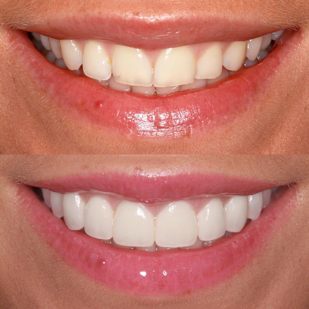 Veneers