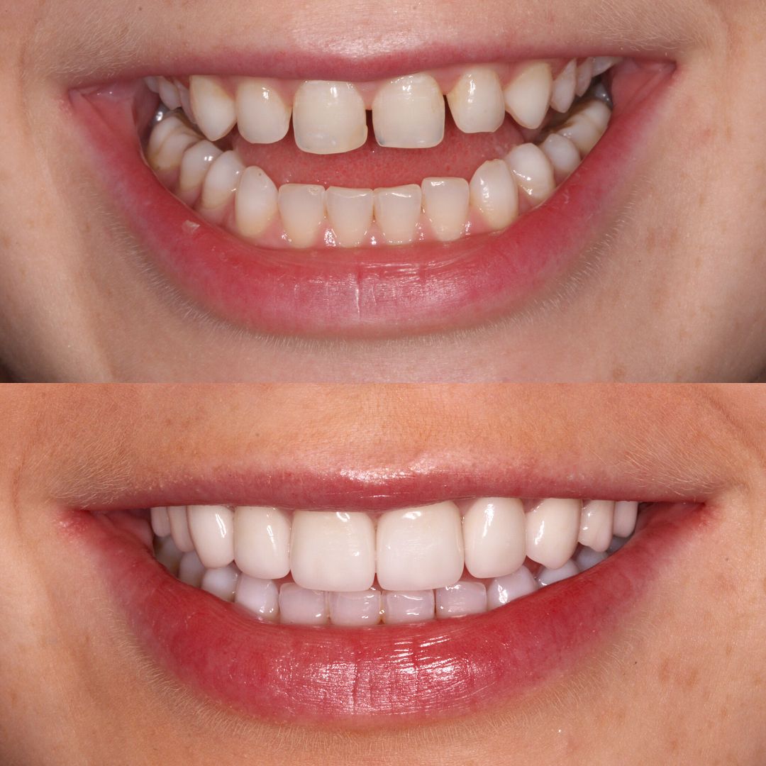 Veneers