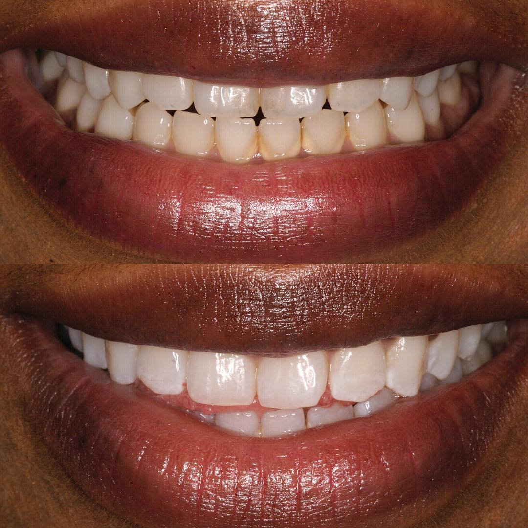 Whitening