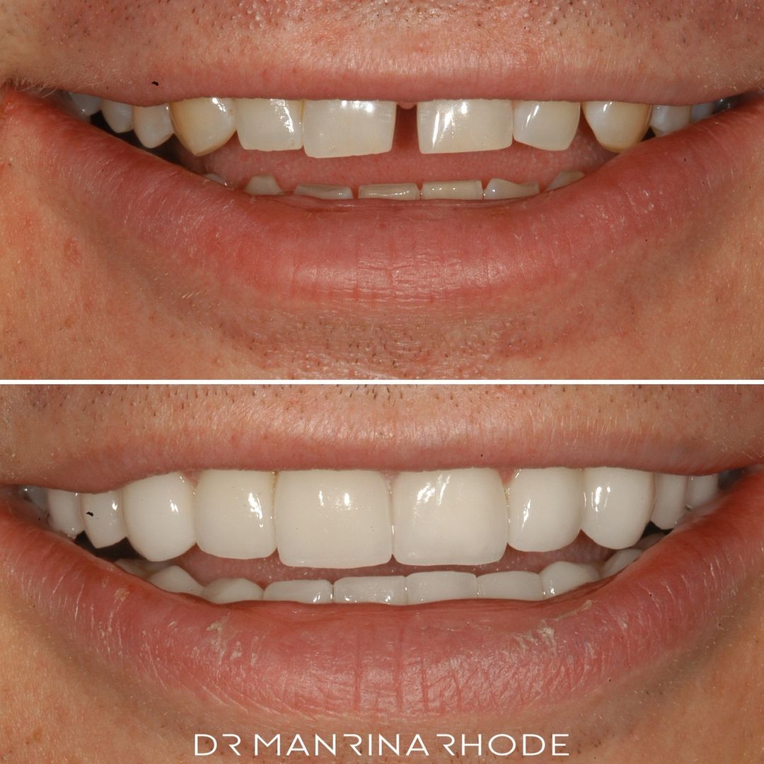 porcelain veneers